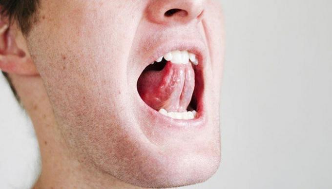 Няколко прости упражнения за гърлото и езика може да облекчи положението с хъркането. / Снимка: i2.wp.com. 